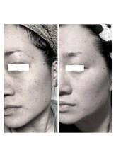 ヒルナム(Heal Nam)/プロセルセラピーズ~フェイス~