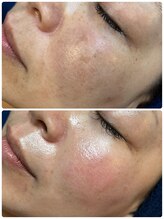 イロドリ(irodori)/肌改善♪クリアな素肌へ☆