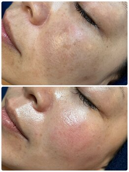 イロドリ(irodori)/肌改善♪クリアな素肌へ☆