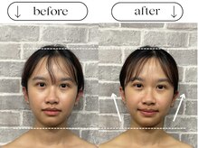 ビースタイル(B-style)/【電気美容鍼】ビフォーアフター