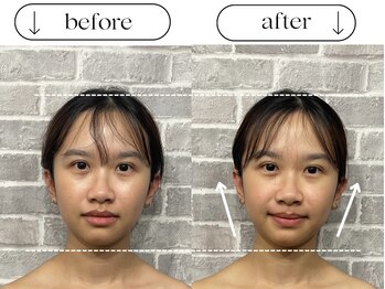 ビースタイル(B-style)/【電気美容鍼】ビフォーアフター