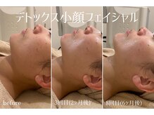 ハティア(hattia)/小顔とエイジングケアを叶える♪