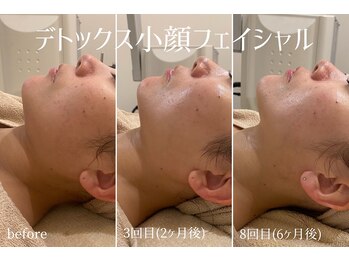 ハティア(hattia)/小顔とエイジングケアを叶える♪