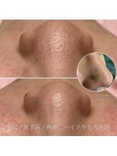 ルナベル(Luna Bell)/ハイドラ毛穴洗浄