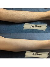 レルア(Relua)/ワックス脱毛の魅力