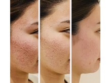 ジ エステティック イーズ サクラマチ熊本店/ピーリング20代/#ニキビ#毛穴