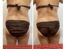 マハロ スコータイ/ビフォーアフター　＜腰＞