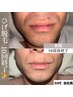 【5月の平日限定！】ひげ脱毛￥3,300