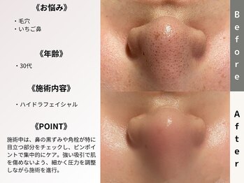 ルディラ 町田店/ハイドラフェイシャル