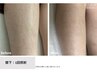 【どこよりも丁寧に！】美肌脱毛 両脚 ３回