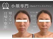 シェリー(Cherie)の雰囲気（フェイスラインんの脂肪スッキリ！エステでできる切らない小顔）