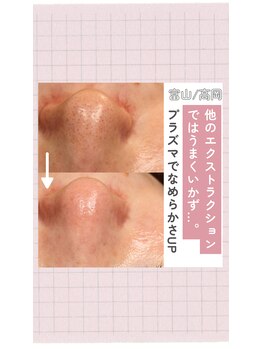 サロン リュンヌ(salon lune)/エクストラクション×プラズマ