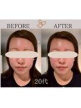 チョコバリ 中目黒店(chocobari)/小顔×リフトアップ(美容鍼)20代