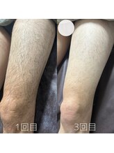 カナウ(KANAU)/足脱毛（20代前半男性）