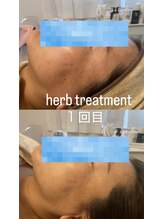 ミイン(miin)/ハーブトリートメント