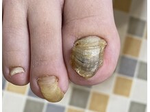 フットメンテ 巻き爪矯正センター 南浦和の雰囲気（肥厚爪・重複爪・変色爪・変形爪・伸びない爪！爪のお悩み解消！）