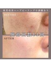 ベルミー(Bellmi)/肌質改善ハーブピーリング(顔)