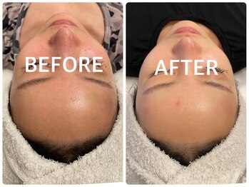 ハーブピーリング 恵比寿/くすみ/毛穴/トーンアップ