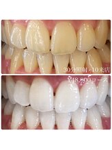 ホワイトニングルーム 川崎店(WhiteningRoom)/ホワイトニング/川崎