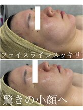 アディス 心斎橋(ADISE) 人気No1 小顔