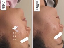 ルビー(Ruby)/【30代】しみケア・4回照射