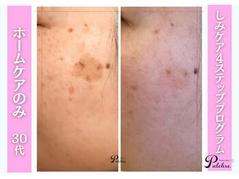 プルクレ 常磐町店(Pulchre)/しみケアプログラム♪