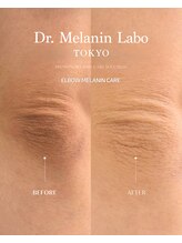 ドクターメラニン ラボ トーキョー 渋谷(Dr. Melanin Labo TOKYO)/肘メラニンケア症例
