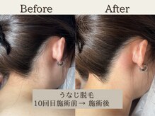 インベスト(INVEST)/うなじ脱毛