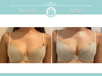 美人バスト 赤羽店/【バストアップ★育乳】症例