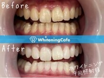 ホワイトニングカフェ赤羽店/ホワイトニングビフォーアフター