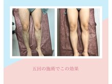 ピノ 西尾店(PINO)/【メンズ脱毛】全身脱毛/足脱毛