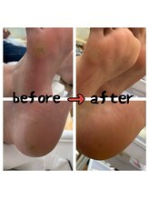 レア(Lea)/角質ディープケア