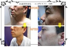 磨凛/エンダモリフト変化