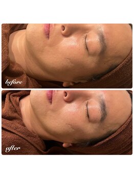 ファビリス 天王寺店(FAVILIS)/メンズフェイシャル幹細胞ケア