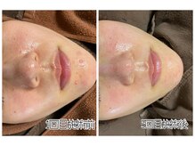 おうちサロン ミキ/肌質改善＊ハーブピーリング