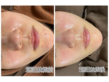 おうちサロン ミキ/肌質改善*ハーブピーリング