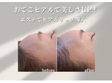 アールメディカルサロン 富山院(R Medical Salon)の雰囲気（ヒアル導入でベビーフェイスに！おでこヒアルで丸く形成）