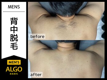 アルゴ 小松店(ALGO)/メンズ背中脱毛