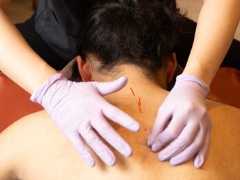 鍼灸院はりセラ 淡路町院の写真/どこに行っても改善されない痛みに◎【部位別オーダーメイド"狙い撃ち"鍼施術 ￥4400】お悩みご相談下さい!