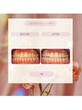 プラスビー 2号店(+b)/ホワイトニングビフォーアフター