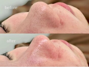 グランビューティ(Glanz Beauty)/毛穴洗浄×イオン導入×顔脱毛