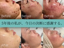 アンドナイン エス店(ANDNINE.)/ニキビケア/ハーブピーリング