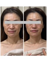 メディカルエース(MedicalAce)/ブライティングリフト