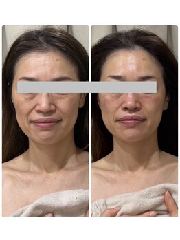 メディカルエース(MedicalAce)/ブライティングリフト