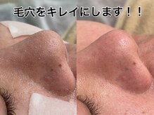 ラカ 長野駅前本店(LaKa)の雰囲気（NEWマシンで毛穴すっきり！！毛穴ケアに自身あり！！）