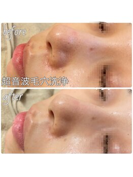 ベルシア ボディアンドアイラッシュ(Belsia)/毛穴洗浄コース