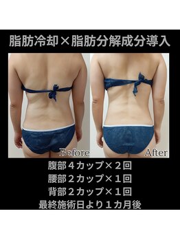 ホワイトビューティーラボ(White Beauty Lab)/【痩身】背中がすっきり