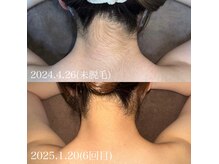 エピジュ(Epijyu)の雰囲気（女性のうなじ脱毛！うなじ脱毛はプロにお任せください♪）