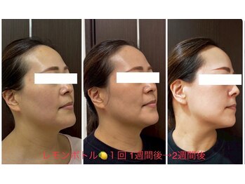 プリオール 太田店(Prior)/エステダーマ×レモンボトル