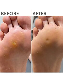 クオッカ(Quokka)/たこ・魚の目ケア